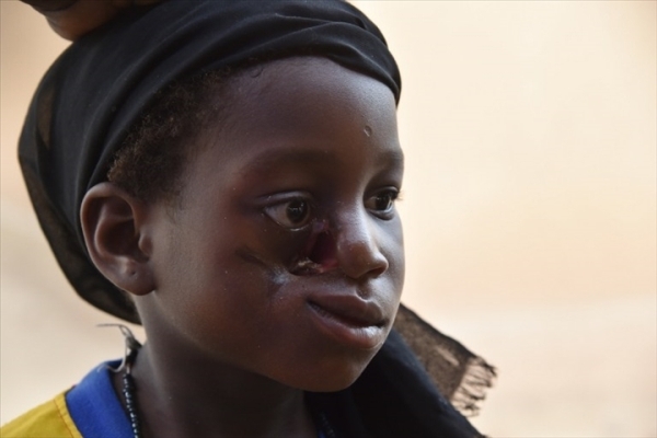 Santé: Le noma, épouvantable maladie de la misère et de la malnutrition